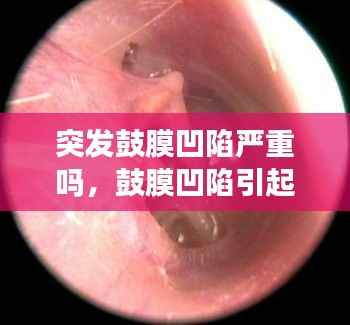 突发鼓膜凹陷严重吗,鼓膜凹陷引起的耳鸣